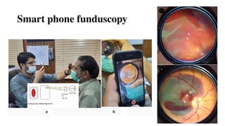 Smart phone funduscopy
 