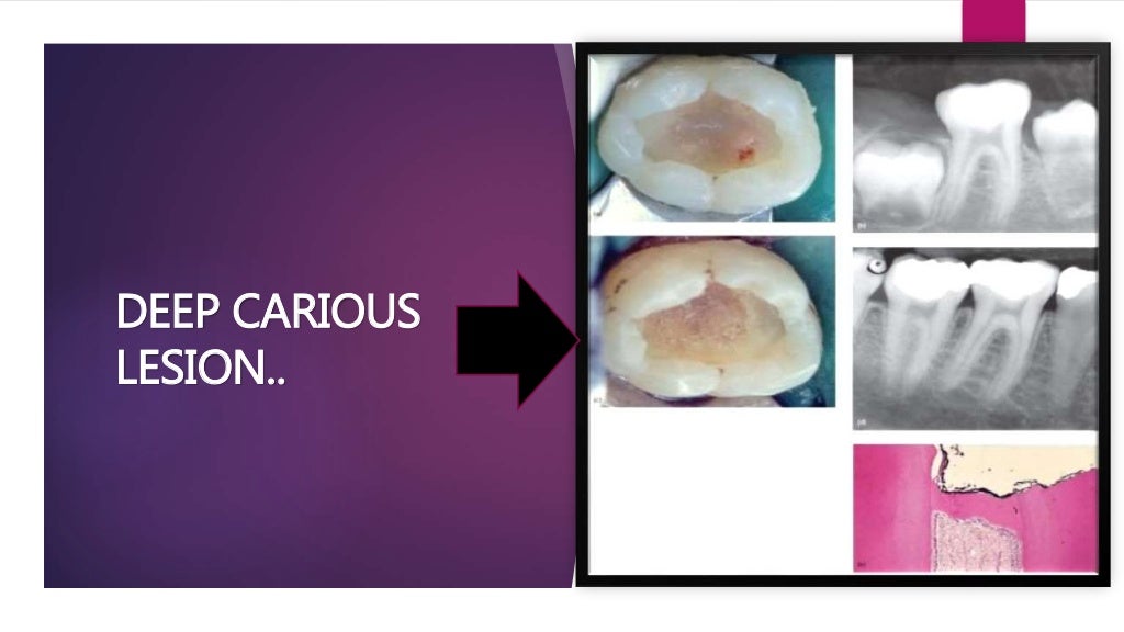 Direct and Indirect pulp capping