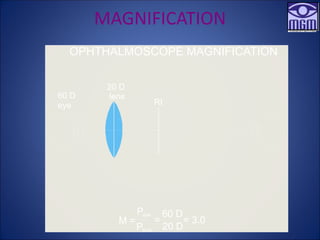 MAGNIFICATION
20 D
lens
RI
60 D
eye
OPHTHALMOSCOPE MAGNIFICATION
Peye
Plens
=
60 D
20 D
= 3.0
M =
 