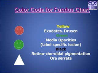 Color Code for Fundus Chart
Yellow
Exudates, Drusen
Green
Media Opacities
(label specific lesion)
Black
Retino-choroidal pigmentation
Ora serrata
 
