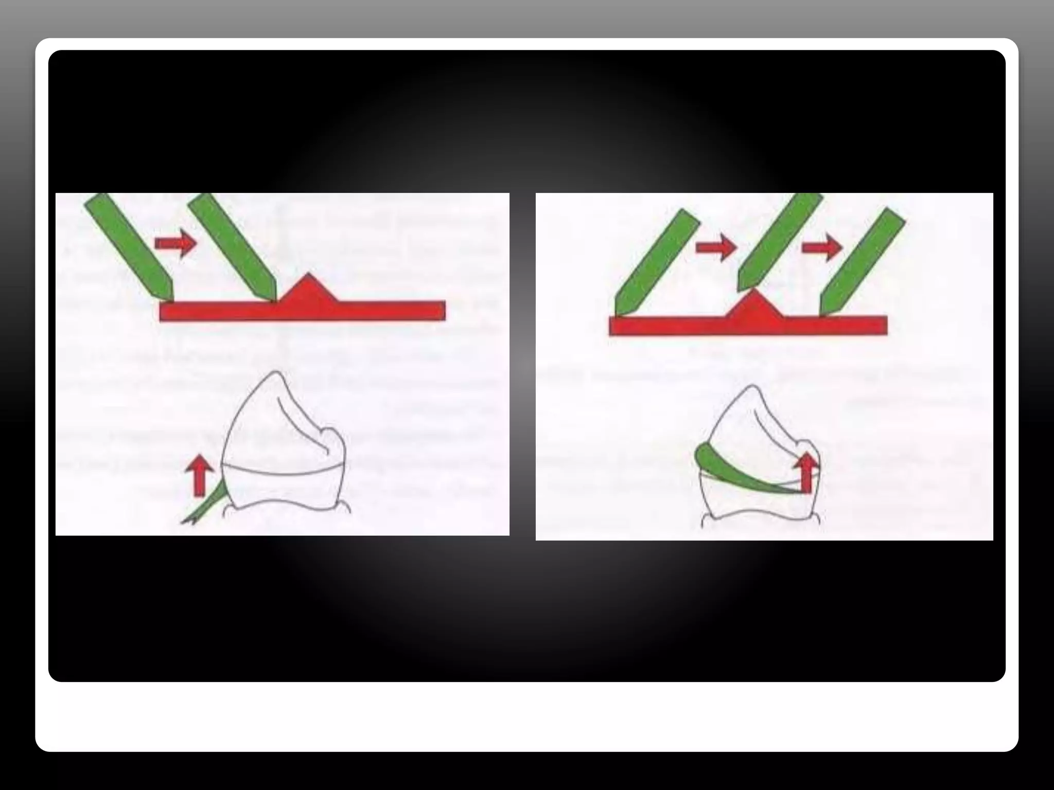 Holding Rpd Retainer Direct & indirect retainers in rpd | PPTX