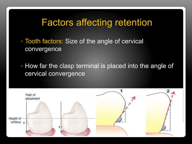 Retainer In Rpd Direct & indirect retainers in rpd | PPTX