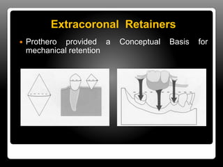 Indirect Retention In Rpd Direct & indirect retainers in rpd | PPTX
