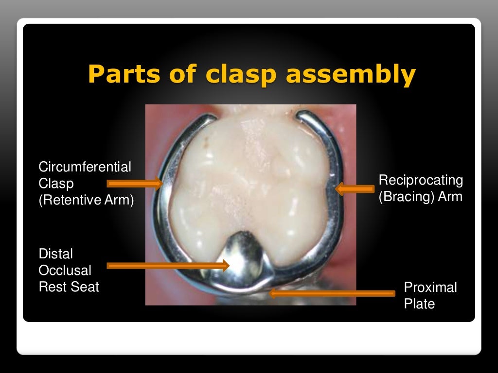 Direct & indirect retainers in rpd