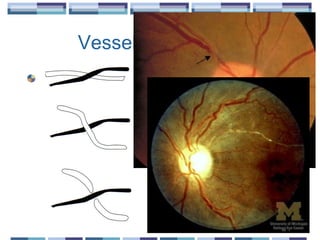 Vessel “Crossings”
Normal crossing
Direction change
“banking’” or “nipping”
 