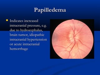 PapilledemaPapilledema
 Indicates increasedIndicates increased
intracranial pressure, e.g.intracranial pressure, e.g.
due to hydrocephalus,due to hydrocephalus,
brain tumor, idiopathicbrain tumor, idiopathic
intracranial hypertensionintracranial hypertension
or acute intracranialor acute intracranial
hemorrhagehemorrhage
 