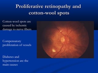 Proliferative retinopathy andProliferative retinopathy and
cotton-wool spotscotton-wool spots
Cotton-wool spots are
caused by ischemic
damage to nerve fibers
Compensatory
proliferation of vessels
Diabetes and
hypertension are the
main causes
 