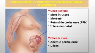 CONSÉQUENCE DE L’INFECTION PLACENTAIRE PAR LE
PLASMODIUM
Chez l’enfant
• Mort in-utero
• Mort-né
• Retard de croissance (PPN)
• Ictère néonatal
Chez la mère
• Anémie pernicieuse
• Décès
 