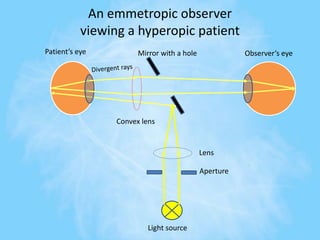 Patient’s eye Observer’s eyeMirror with a hole
Light source
Aperture
Lens
Convex lens
An emmetropic observer
viewing a hyperopic patient
 