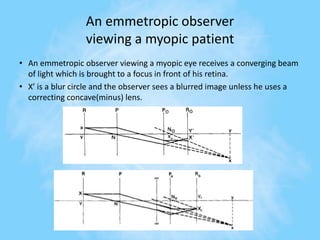 An emmetropic observer
viewing a myopic patient
• An emmetropic observer viewing a myopic eye receives a converging beam
of light which is brought to a focus in front of his retina.
• X’ is a blur circle and the observer sees a blurred image unless he uses a
correcting concave(minus) lens.
 