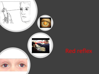 Red reflex
 