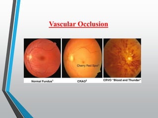 Vascular Occlusion
 
