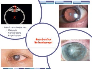 • Look for media opacities
• Cataracts
• Corneal scars
• Large floaters
 