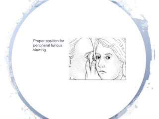 Proper position for
peripheral fundus
viewing
 