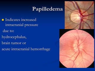 Papilledema
 Indicates increased
intracranial pressure
due to:
hydrocephalus,
brain tumor or
acute intracranial hemorrhage
 