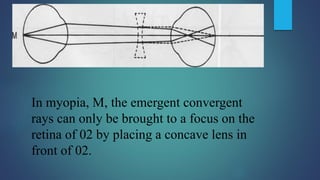In myopia, M, the emergent convergent
rays can only be brought to a focus on the
retina of 02 by placing a concave lens in
front of 02.
 