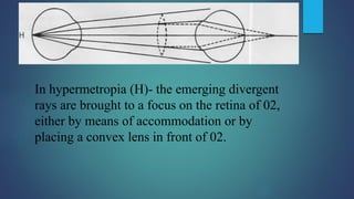In hypermetropia (H)- the emerging divergent
rays are brought to a focus on the retina of 02,
either by means of accommodation or by
placing a convex lens in front of 02.
 
