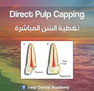 Direct Pulp Capping - An Overview