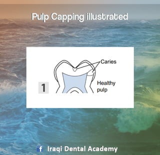 capping pulp overview