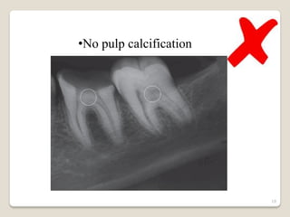 •No pulp calcification




                         10
 