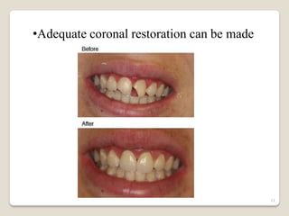 •Adequate coronal restoration can be made




                                            11
 