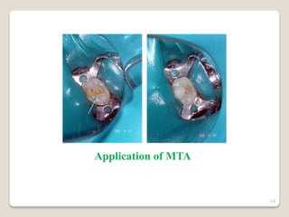 Direct pulp capping | PDF