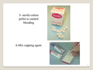 5- sterile cotton
  pellet to control
      bleeding




6-Mix capping agent




                      42
 