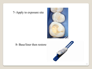 Direct pulp capping | PDF