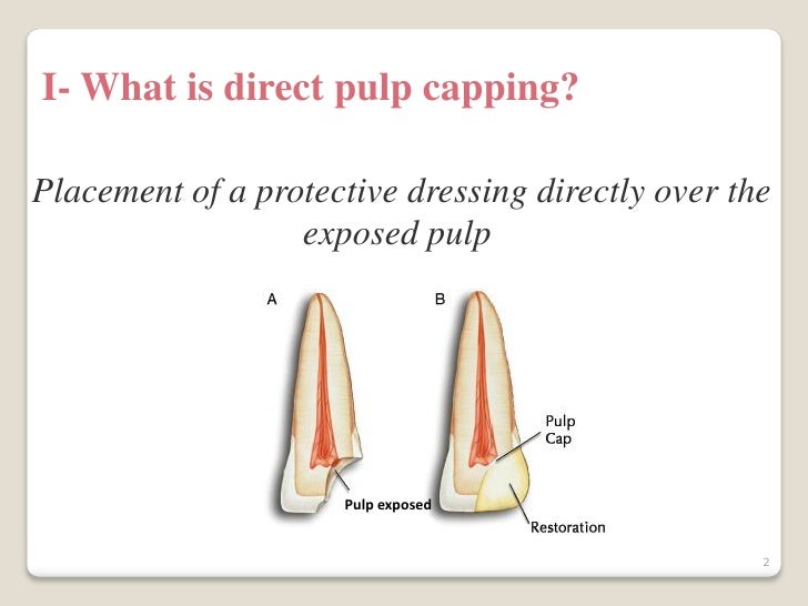 indirect pulp cap