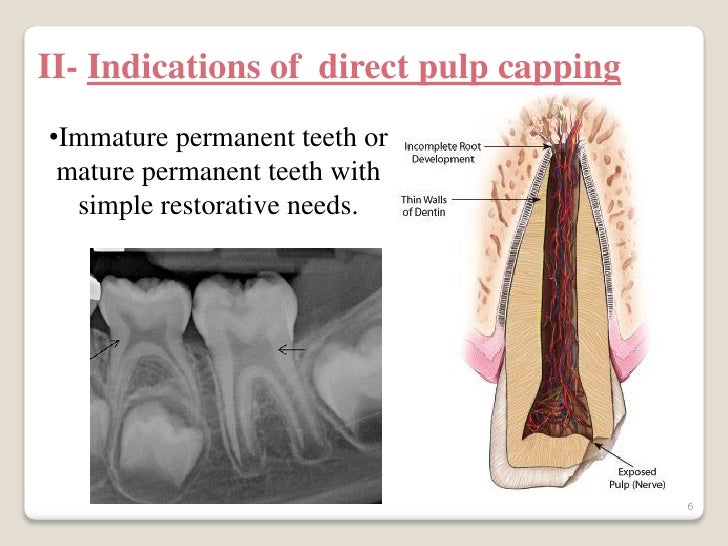 Direct pulp capping