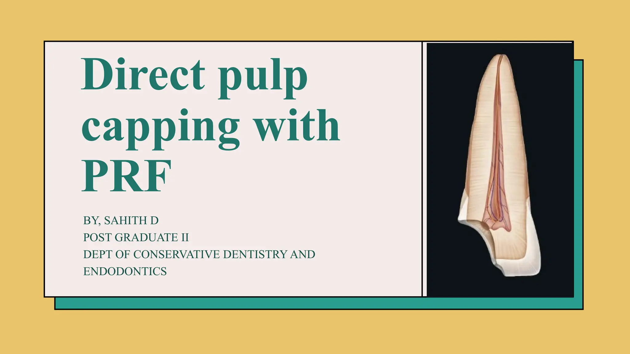 Direct pulp capping with PRF idm topic.pptx