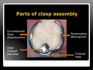 direct retainer in Cast partial Dentures.pptx