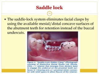 Saddle lock
 The saddle-lock system eliminates facial clasps by
using the available mesial/distal concave surfaces of
the abutment teeth for retention instead of the buccal
undercuts.
86
 