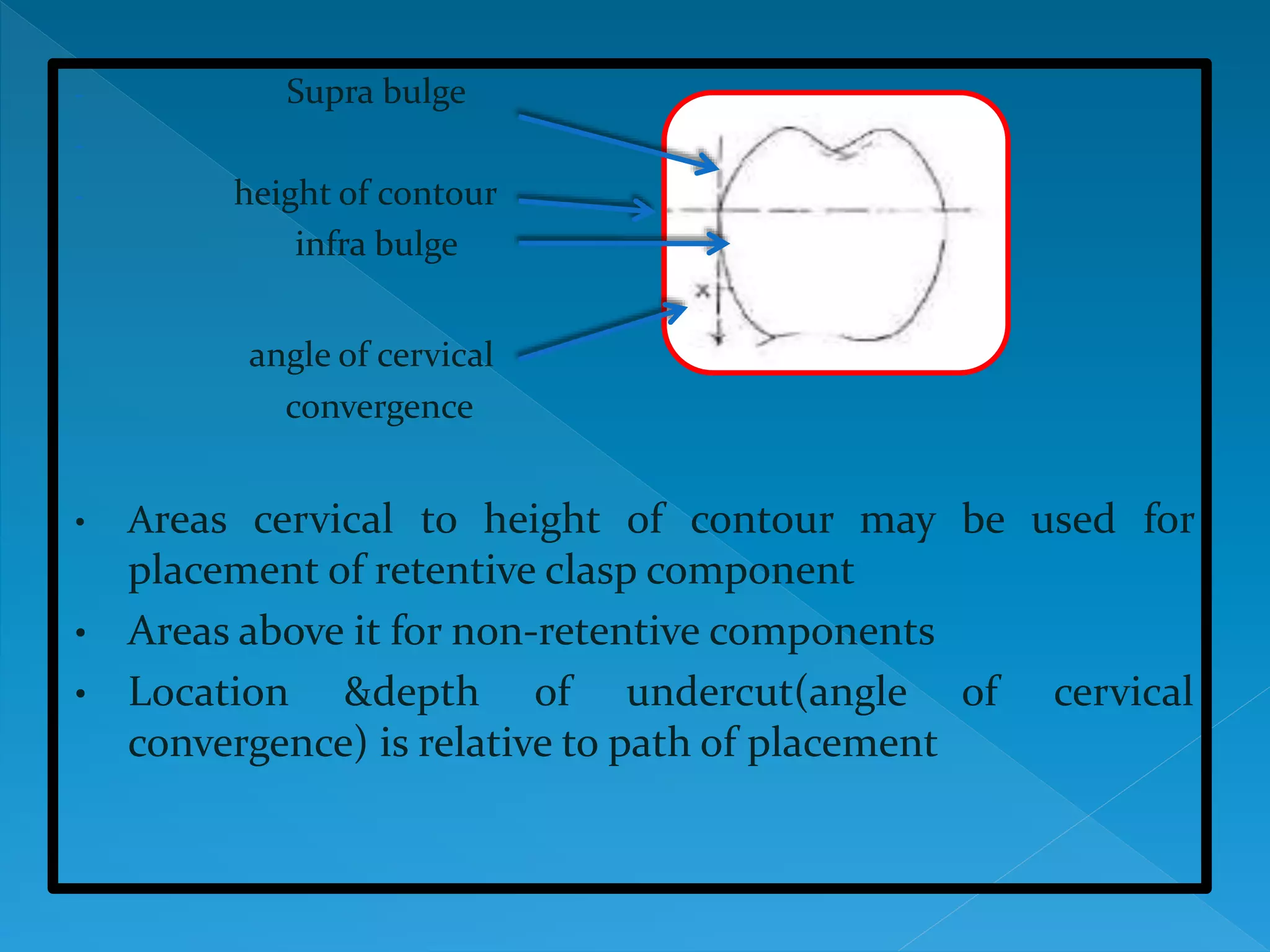 - Supra bulge
-
- height of contour
infra bulge
angle of cervical
convergence
• Areas cervical to height of contour may be used for
placement of retentive clasp component
• Areas above it for non-retentive components
• Location &depth of undercut(angle of cervical
convergence) is relative to path of placement
 