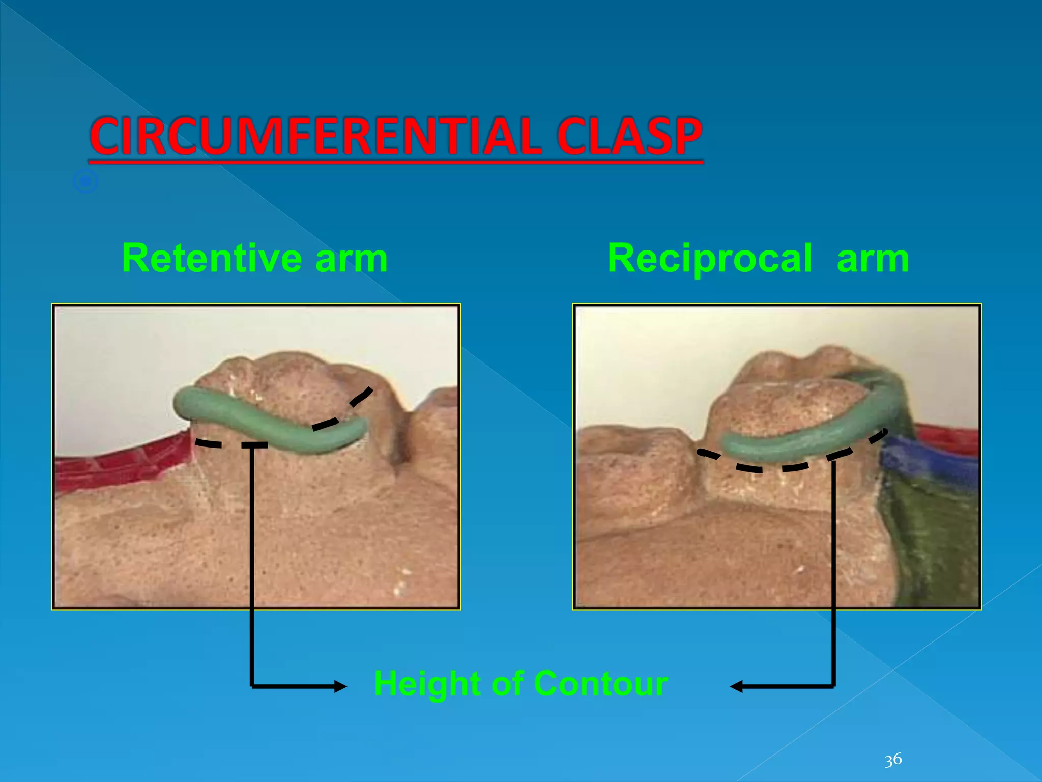 36

Height of Contour
Retentive arm Reciprocal arm
 