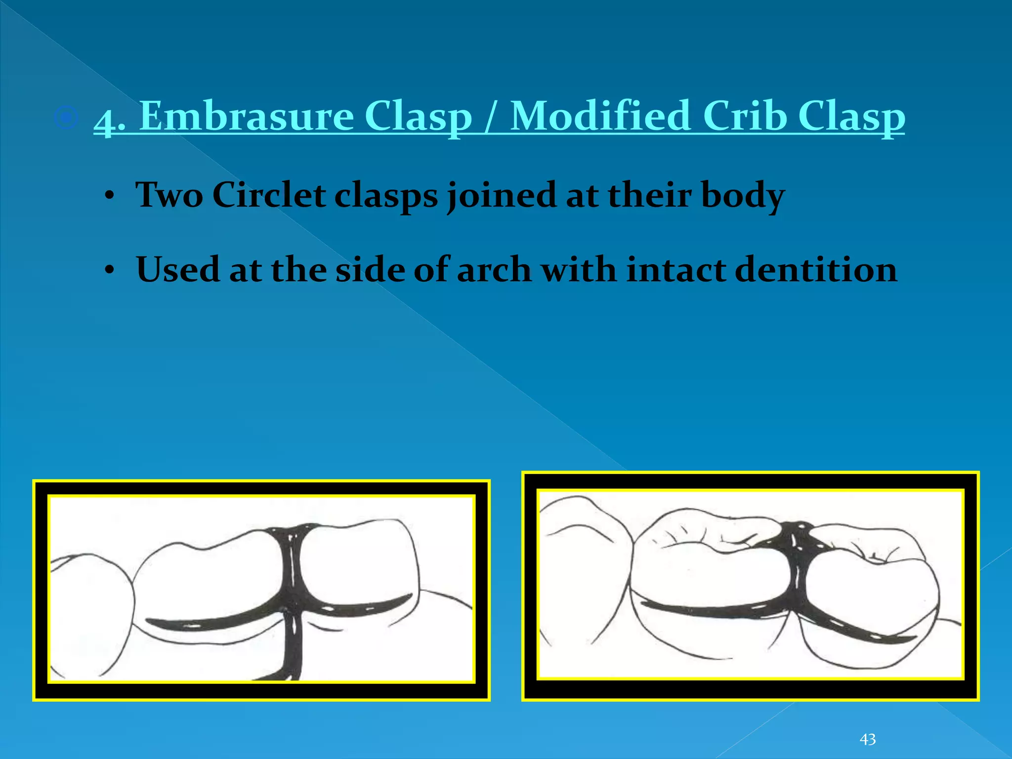 43
 4. Embrasure Clasp / Modified Crib Clasp
• Two Circlet clasps joined at their body
• Used at the side of arch with intact dentition
 