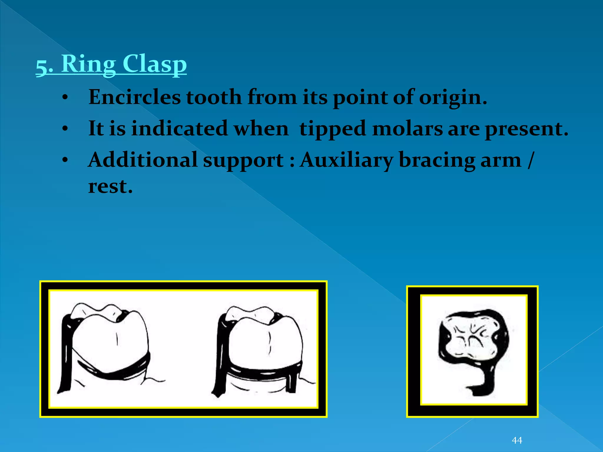 44
5. Ring Clasp
• Encircles tooth from its point of origin.
• It is indicated when tipped molars are present.
• Additional support : Auxiliary bracing arm /
rest.
 