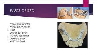 Direct retainers pptx department of prosthodontics | PPTX