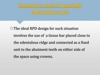 Kennedy’s class IV partially 
edentulous arch 
The ideal RPD design for such situation 
involves the use of a tissue bar placed close to 
the edentulous ridge and connected as a fixed 
unit to the abutment teeth on either side of 
the space using crowns. 
 