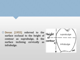  Devan [1955] referred to the 
surface occlusal to the height of 
contour as suprabulge, & the 
surface inclining cervically as 
infrabulge. 
suprabulge 
infrabulge 
 