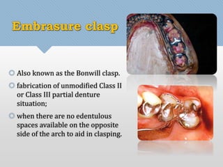 Embrasure clasp 
 Also known as the Bonwill clasp. 
 fabrication of unmodified Class II 
or Class III partial denture 
situation; 
 when there are no edentulous 
spaces available on the opposite 
side of the arch to aid in clasping. 
 