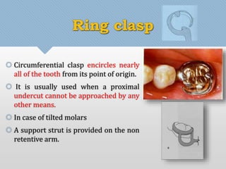 Ring clasp 
 Circumferential clasp encircles nearly 
all of the tooth from its point of origin. 
 It is usually used when a proximal 
undercut cannot be approached by any 
other means. 
 In case of tilted molars 
 A support strut is provided on the non 
retentive arm. 
 