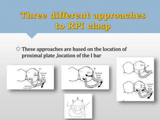 Three different approaches 
to RPI clasp 
 These approaches are based on the location of 
proximal plate ,location of the I bar 
 