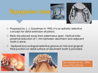 Equipoise clasp 
 Proposed by J. J. Goodman in 1990, it is an esthetic retentive 
concept for distal extension situations. 
 Rests are placed away from edentulous span. Vertical inter-proximal 
reduction of 1 mm between abutment and adjacent 
tooth is done. 
 Optional bucco-lingual retentive groove at mid and gingival 
third junction on distal surface of abutment tooth is provided. 
Quintessence Int. 1996 
May;27(5):333-40. 
 