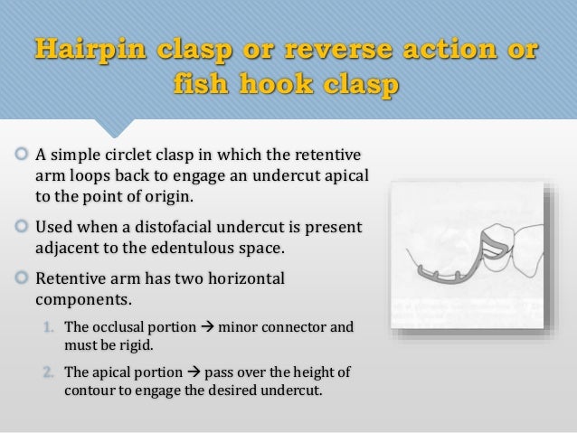 hairpin clasp Direct retainers in removable partial dentures hairpin clasp Direct retainers in removable partial dentures