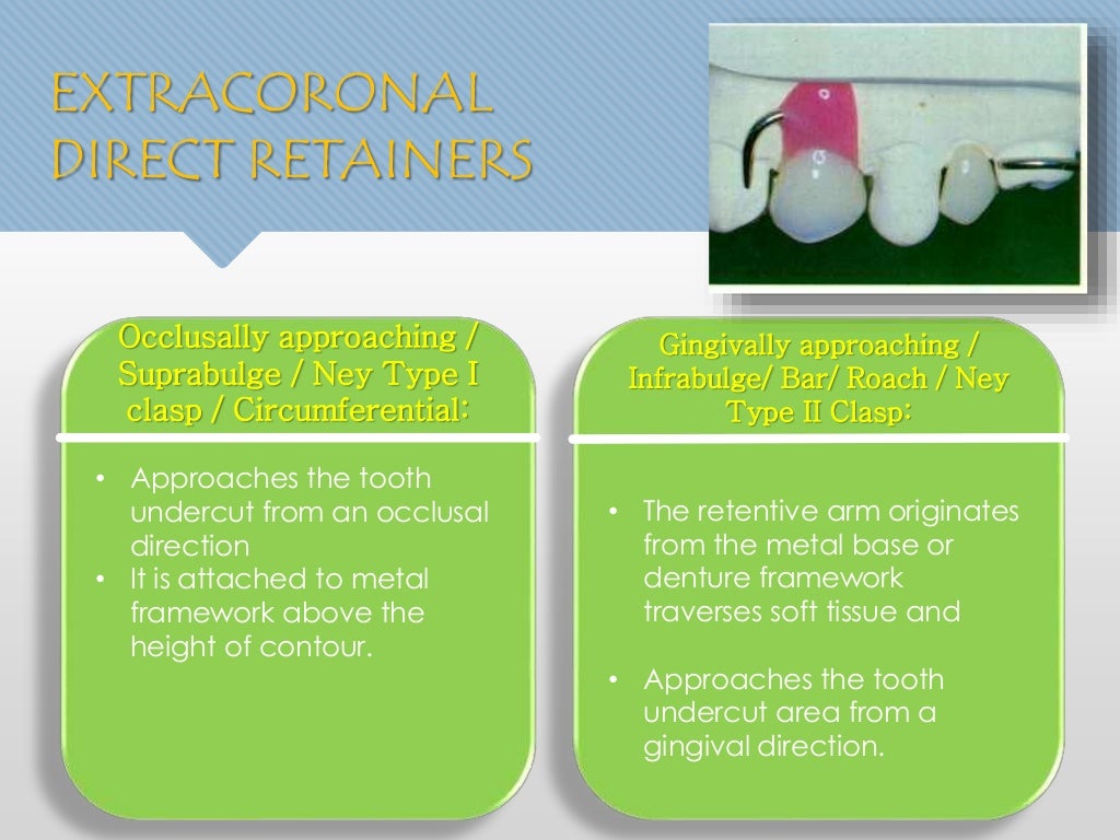 Direct retainers in removable partial dentures