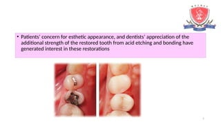 5
• Patients’ concern for esthetic appearance, and dentists’ appreciation of the
additional strength of the restored tooth from acid etching and bonding have
generated interest in these restorations
 