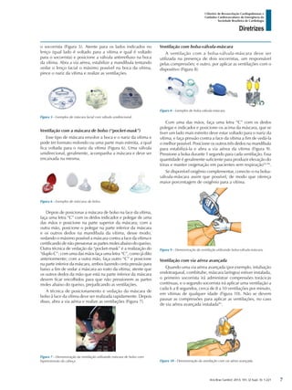 Arq Bras Cardiol: 2013; 101, (2 Supl. 3): 1-221
Diretrizes
I Diretriz de Ressuscitação Cardiopulmonar e
Cuidados Cardiovasculares de Emergência da
Sociedade Brasileira de Cardiologia
o socorrista (Figura 5). Atente para os lados indicados no
lenço (qual lado é voltado para a vítima e qual é voltado
para o socorrista) e posicione a válvula antirrefluxo na boca
da vítima. Abra a via aérea, estabilize a mandíbula tentando
vedar o lenço facial o máximo possível na boca da vítima,
pince o nariz da vítima e realize as ventilações.
Ventilação com bolsa-válvula-máscara
A ventilação com a bolsa-válvula-máscara deve ser
utilizada na presença de dois socorristas, um responsável
pelas compressões; e outro, por aplicar as ventilações com o
dispositivo (Figura 8).
Figura 5 - Exemplos de máscara facial com válvula unidirecional.
Figura 8 - Exemplos de bolsa-válvula-máscara.
Figura 9 - Demonstração da ventilação utilizando bolsa-válvula-máscara.
Figura 6 - Exemplos de máscaras de bolso.
Figura 7 - Demonstração da ventilação utilizando máscara de bolso com
hiperextensão da cabeça.
Ventilação com a máscara de bolso (“pocket-mask”)
Esse tipo de máscara envolve a boca e o nariz da vítima e
pode ter formato redondo ou uma parte mais estreita, a qual
fica voltada para o nariz da vítima (Figura 6). Uma válvula
unidirecional, geralmente, acompanha a máscara e deve ser
encaixada na mesma.
Depois de posicionar a máscara de bolso na face da vítima,
faça uma letra “C” com os dedos indicador e polegar de uma
das mãos e posicione na parte superior da máscara; com a
outra mão, posicione o polegar na parte inferior da máscara
e os outros dedos na mandíbula da vítima, desse modo,
vedando o máximo possível a máscara contra a face da vítima e
certificando de não pressionar as partes moles abaixo do queixo.
Outra técnica de vedação da “pocket-mask” é a realização do
“duplo C”: com uma das mãos faça uma letra “C”, como já dito
anteriormente; com a outra mão, faça outro “C” e posicione
na parte inferior da máscara, ambos fazendo certa pressão para
baixo a fim de vedar a máscara ao rosto da vítima; atente que
os outros dedos da mão que está na parte inferior da máscara
devem ficar encolhidos para que não pressionem as partes
moles abaixo do queixo, prejudicando as ventilações.
A técnica de posicionamento e vedação da máscara de
bolso à face da vítima deve ser realizada rapidamente. Depois
disso, abra a via aérea e realize as ventilações (Figura 7).
Com uma das mãos, faça uma letra “C” com os dedos
polegar e indicador e posicione-os acima da máscara, que se
tiver um lado mais estreito deve estar voltado para o nariz da
vítima, e faça pressão contra a face da vítima a fim de vedá-la
o melhor possível. Posicione os outros três dedos na mandíbula
para estabilizá-la e abra a via aérea da vítima (Figura 9).
Pressione a bolsa durante 1 segundo para cada ventilação. Essa
quantidade é geralmente suficiente para produzir elevação do
tórax e manter oxigenação em pacientes sem respiração92-94
.
Se disponível oxigênio complementar, conecte-o na bolsa-
válvula-máscara assim que possível, de modo que ofereça
maior porcentagem de oxigênio para a vítima.
Ventilação com via aérea avançada
Quando uma via aérea avançada (por exemplo, intubação
endotraqueal, combitube, máscara laríngea) estiver instalada,
o primeiro socorrista irá administrar compressões torácicas
contínuas, e o segundo socorrista irá aplicar uma ventilação a
cada 6 a 8 segundos, cerca de 8 a 10 ventilações por minuto,
em vítimas de qualquer idade (Figura 10). Não se devem
pausar as compressões para aplicar as ventilações, no caso
de via aérea avançada instalada95
.
Figura 10 - Demonstração da ventilação com via aérea avançada.
7
 