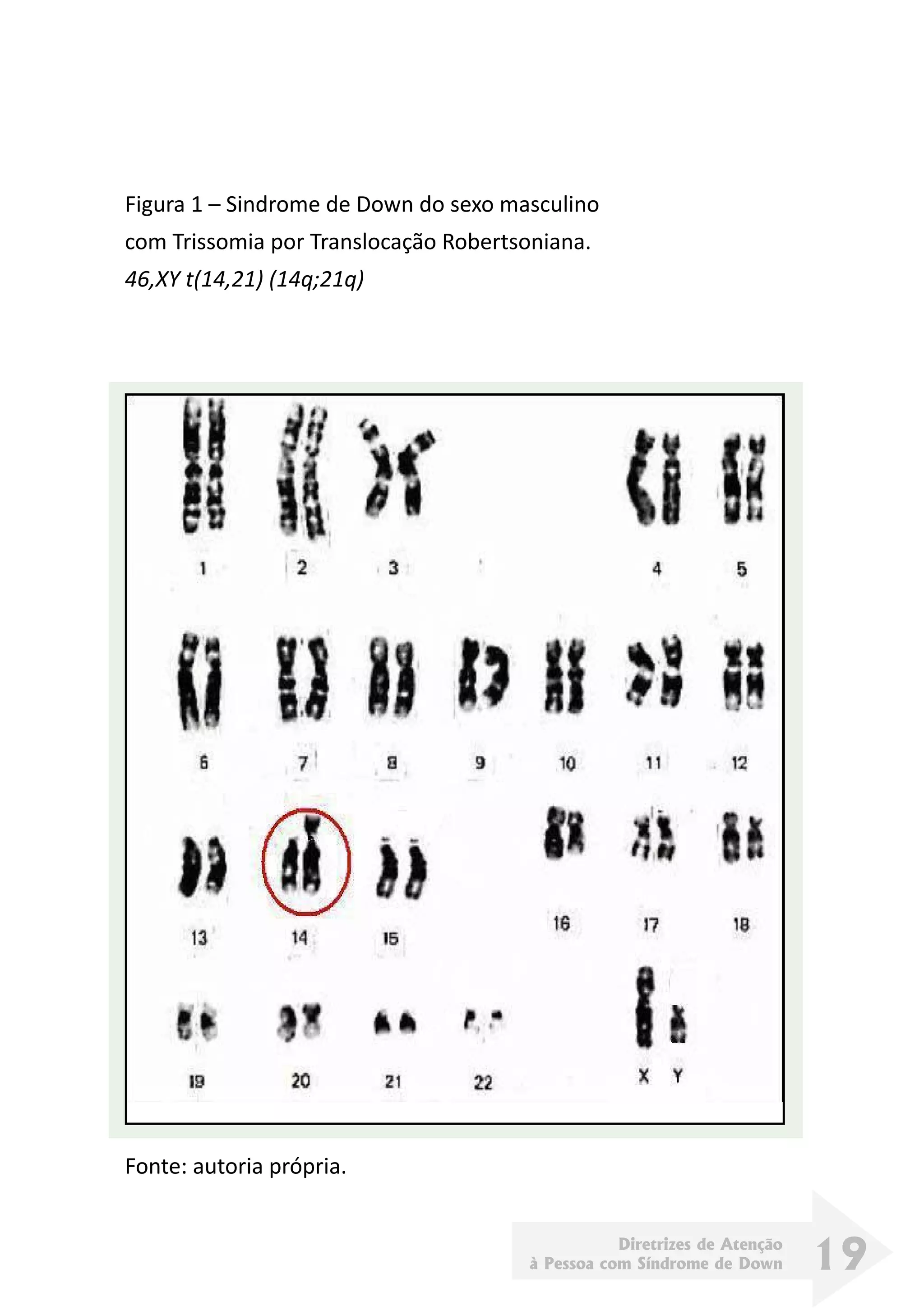 Diretrizes de Atenção
à Pessoa com Síndrome de Down 19
Figura 1 – Sindrome de Down do sexo masculino
com Trissomia por Translocação Robertsoniana.
46,XY t(14,21) (14q;21q)
Fonte: autoria própria.
 