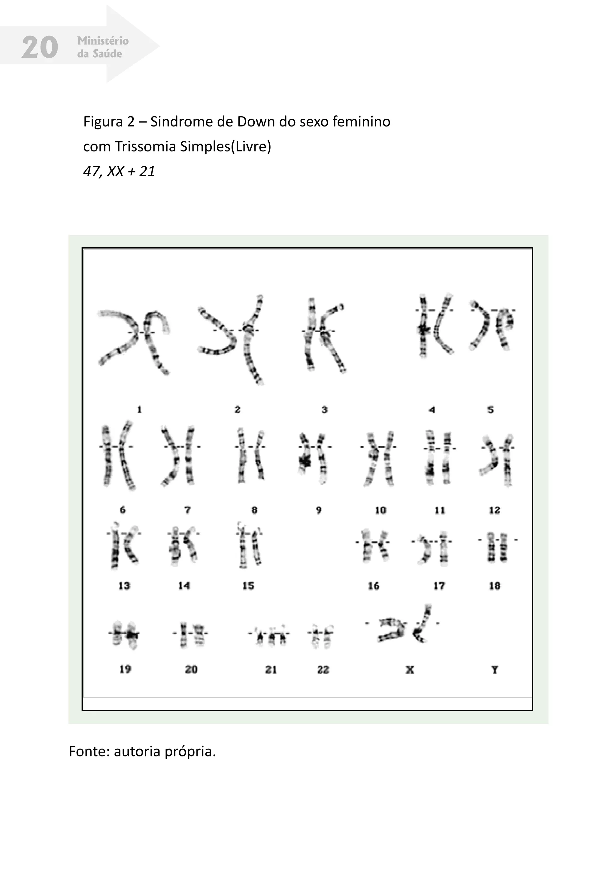 Ministério
da Saúde20
Figura 2 – Sindrome de Down do sexo feminino
com Trissomia Simples(Livre)
47, XX + 21
Fonte: autoria própria.
 